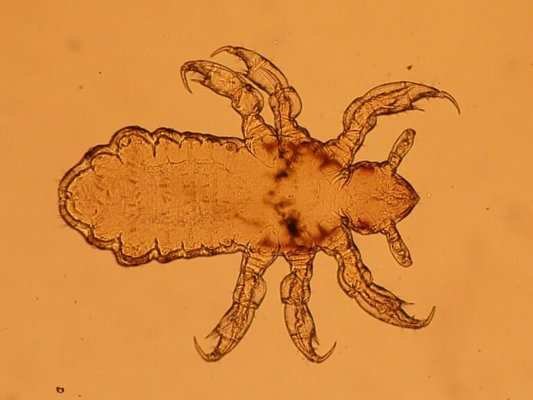 सिर में जूं होना – Head Lice in Hindi