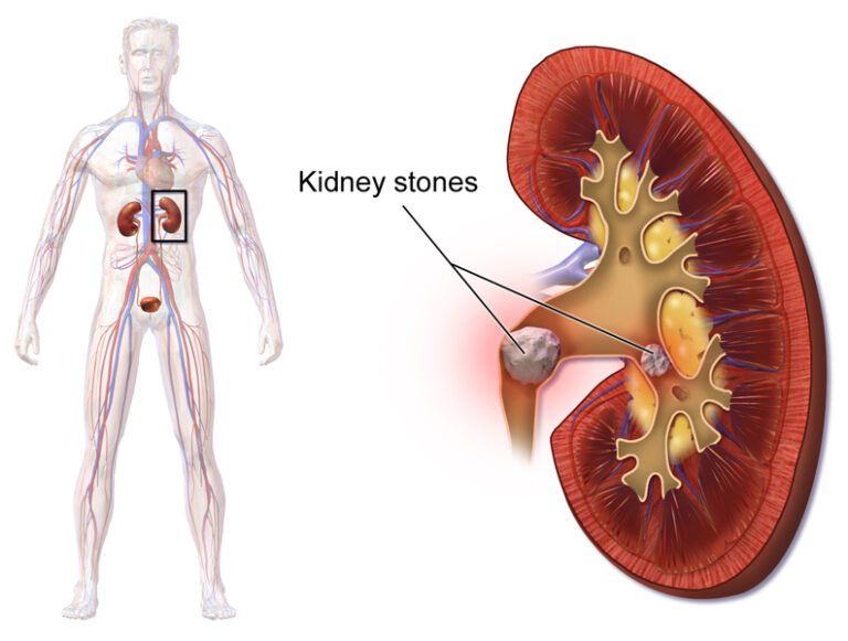 पथरी (किडनी स्टोन) – Kidney Stone in Hindi