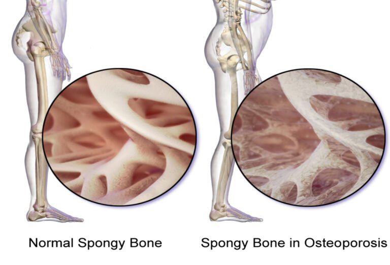 ऑस्टियोपोरोसिस (हड्डियों की कमजोरी) – Osteoporosis in Hindi