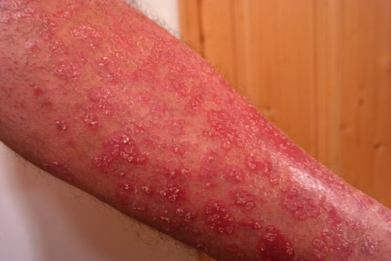 सोरायसिस – Psoriasis in Hindi